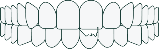 Chipped teeth